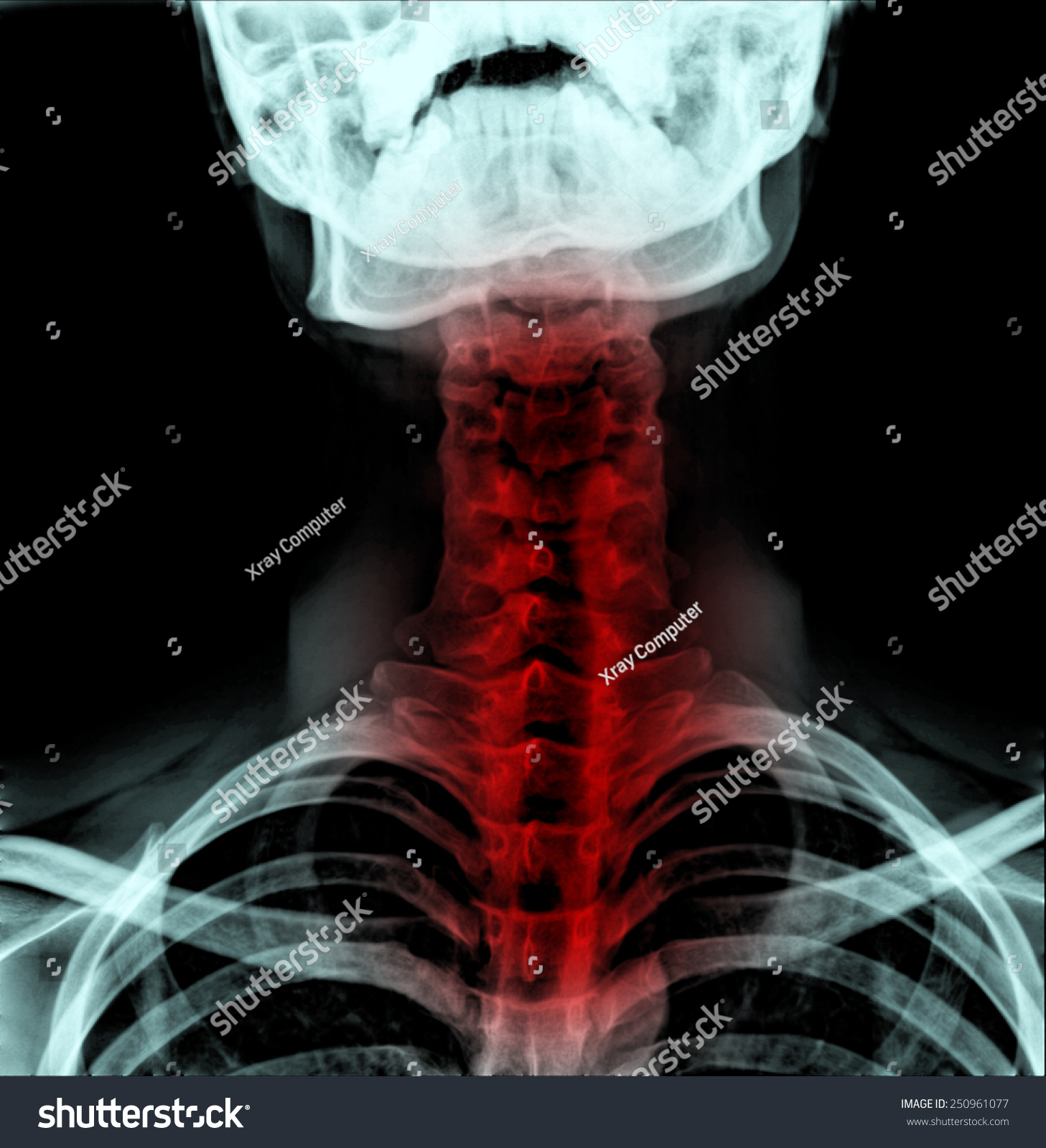 Xray Image Abnormalities Patient Neck Bone Stock Photo 250961077 ...