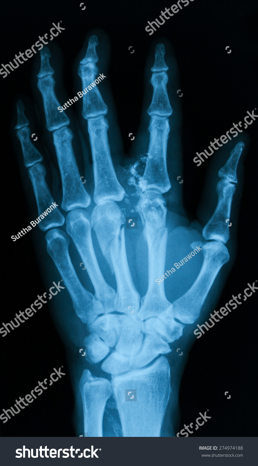 X-Ray Image Of Broken Hand, Ap View, Show Metacarpal Fractures. Stock ...