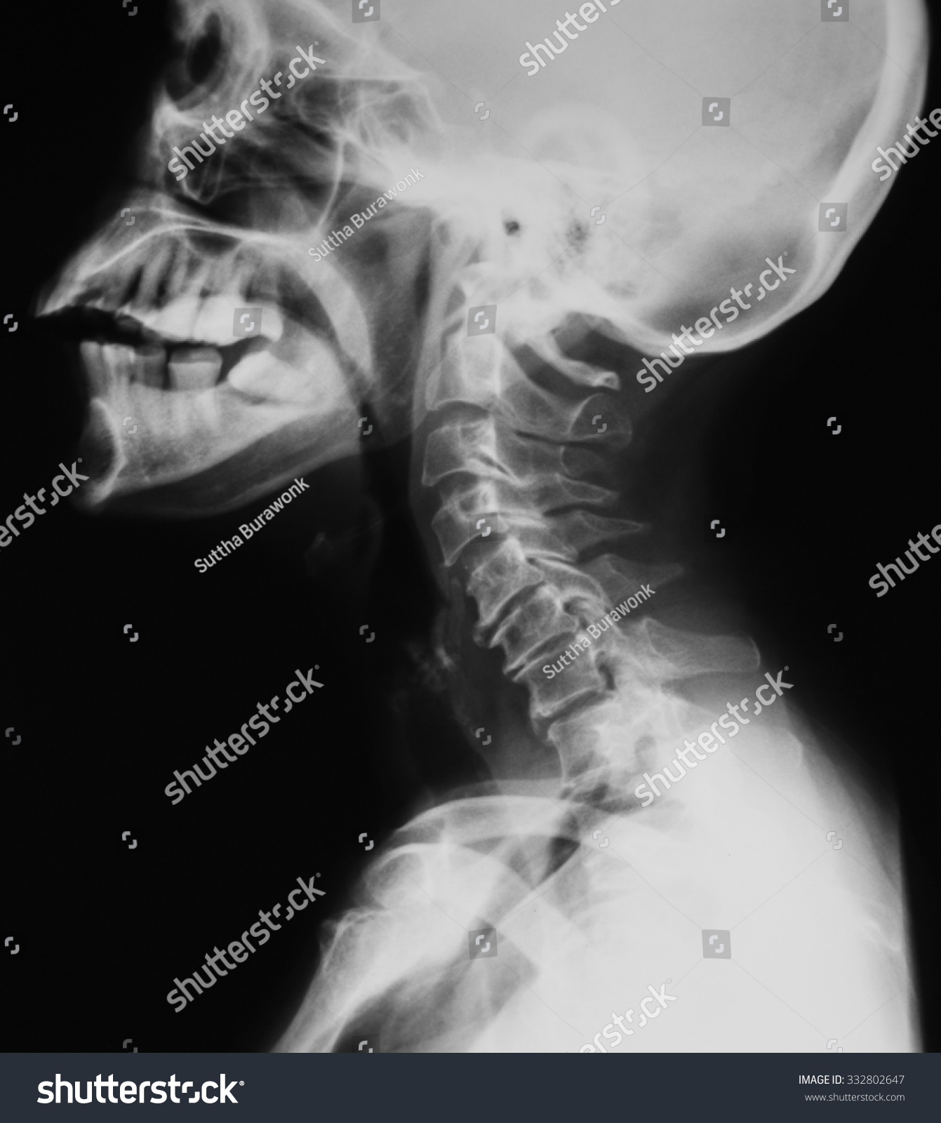 Xray Image Cervical Spine View Shows Stock Photo 332802647 ...
