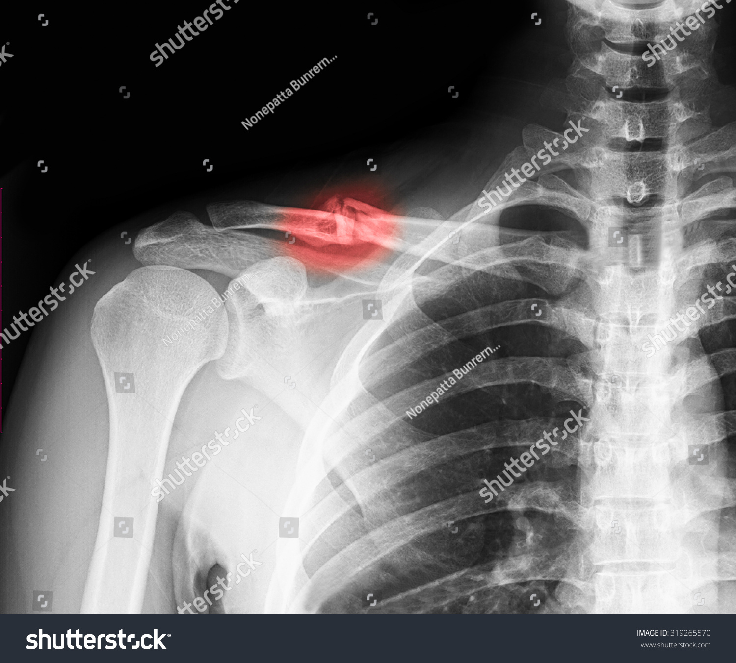 Xray Image Clavicle Clavicle Fracture Stock Photo 319265570 - Shutterstock