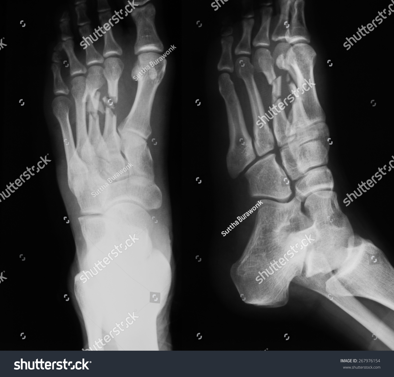 X-Ray Image Of Foot, Ap And Oblique View, Show Fracture Of The Second ...