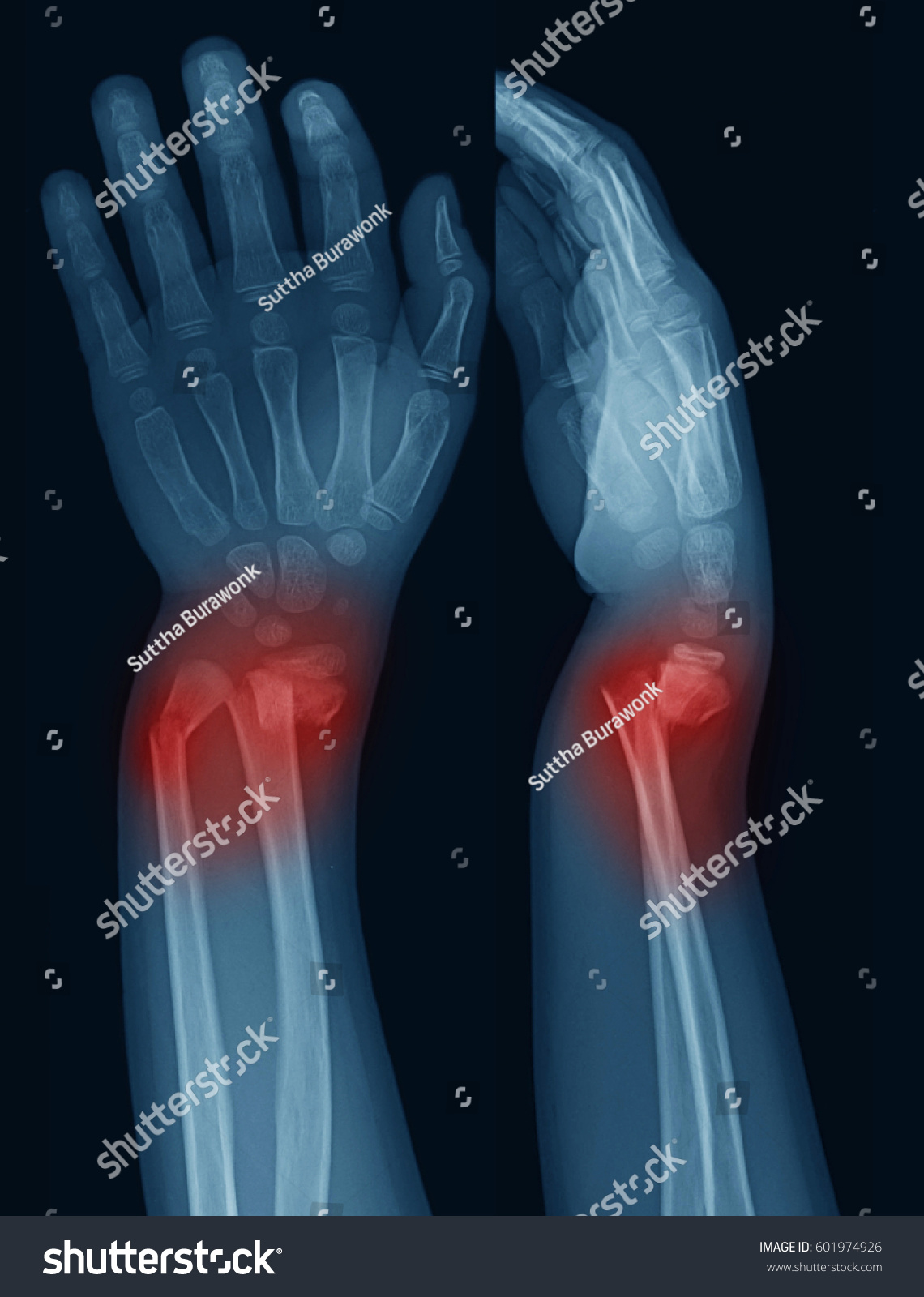 Xray Image Forearm Apanteroposterior Lateral Views Stock Photo ...