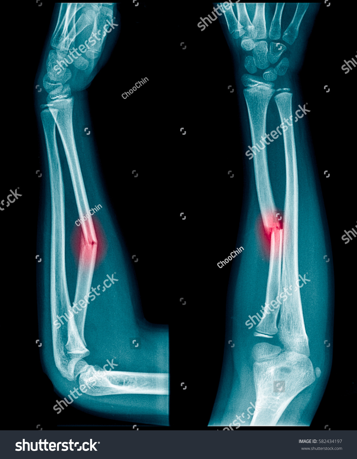 109 African american kid injured Images, Stock Photos & Vectors ...