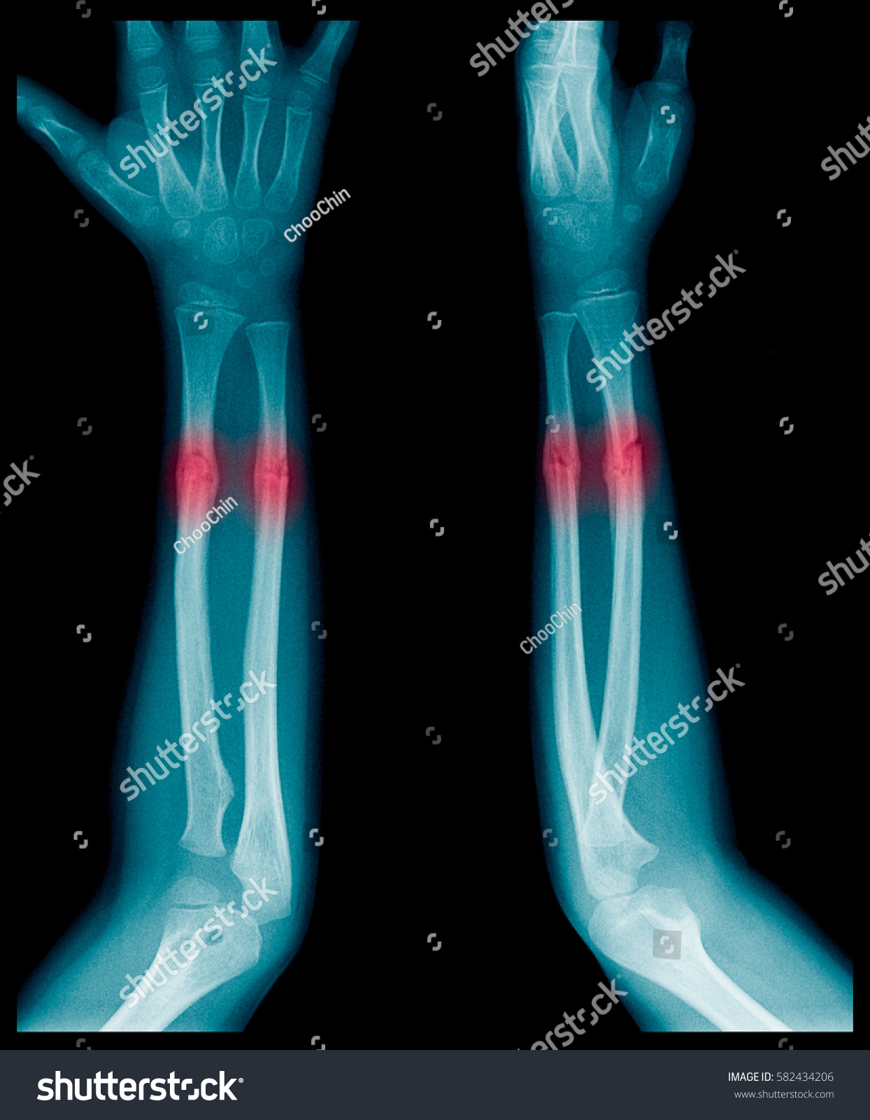 Xray Image Forearm Bone Fracture Childs Stock Photo Edit Now 582434206