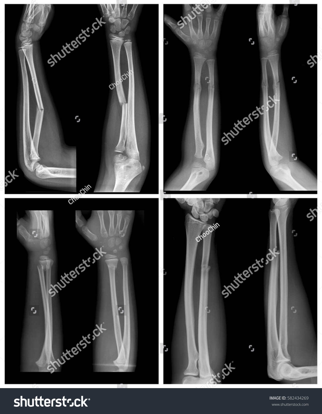 Xray Image Forearm Bone Fracture Childs Stock Photo Edit Now 582434269