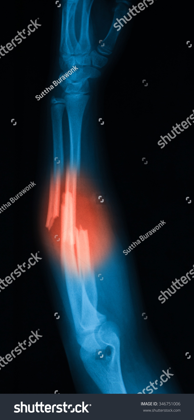 X-Ray Image Of Forearm, Lateral View. Show Ulna And Radius Fractures ...