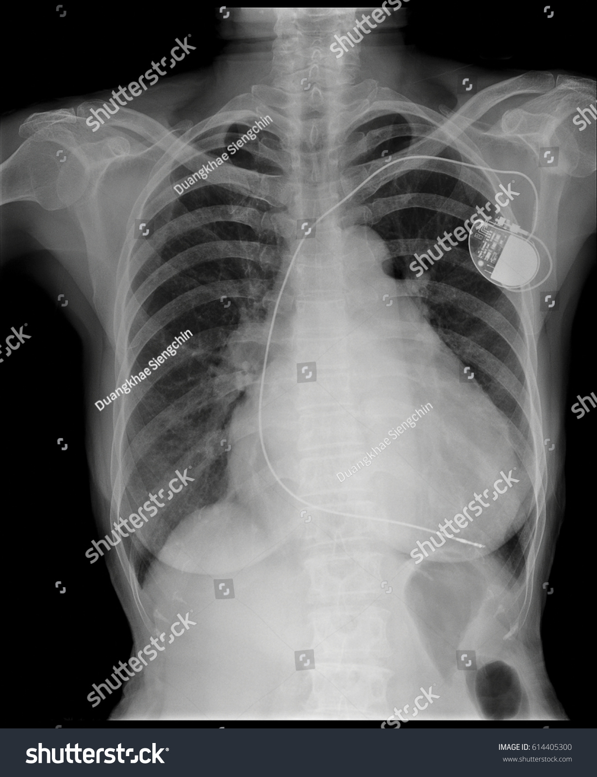 Xray Image Human Body Chest Show Stock Photo (Edit Now) 614405300