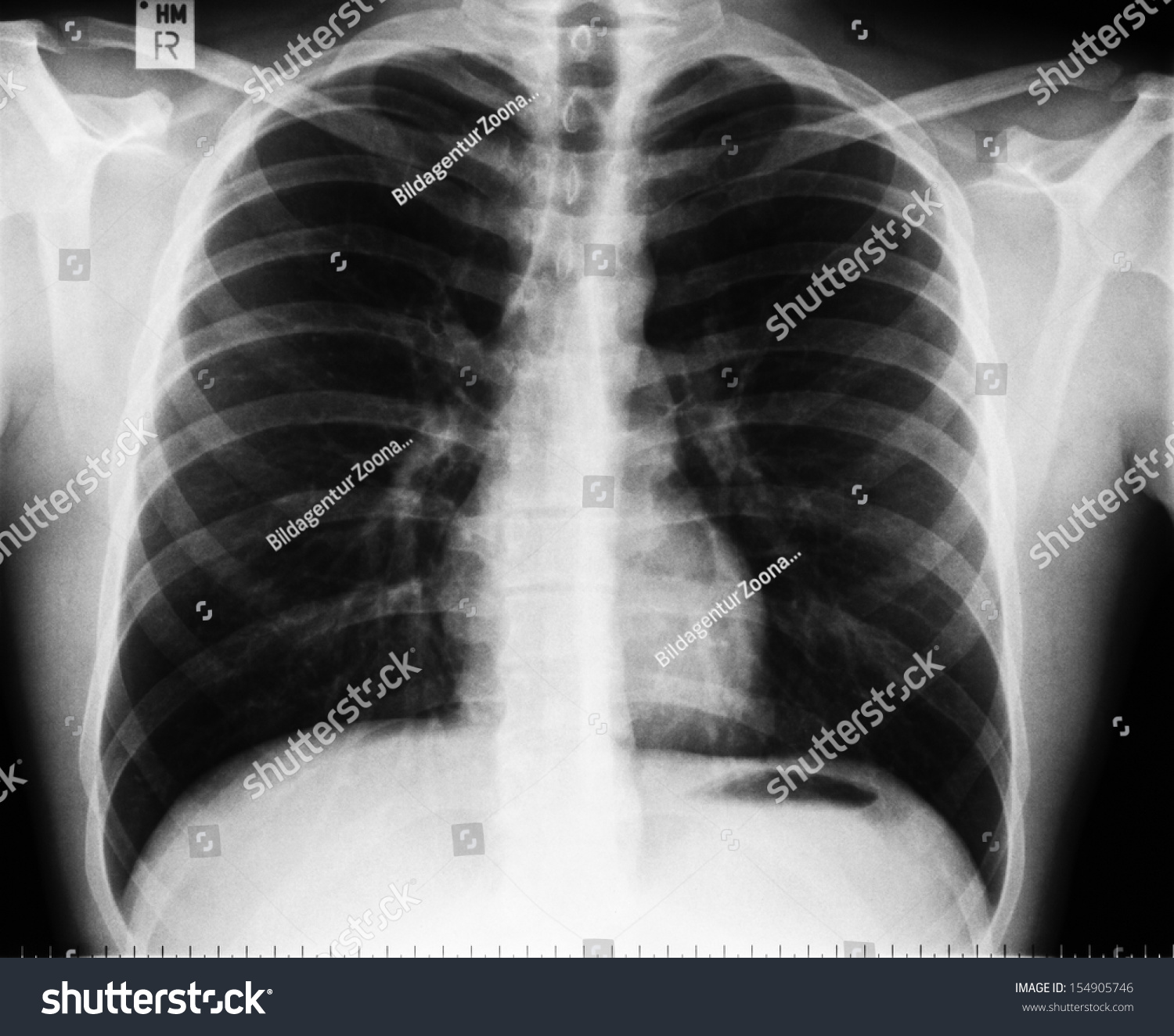 Xray Image Human Chest Without Any Stock Photo 154905746 | Shutterstock