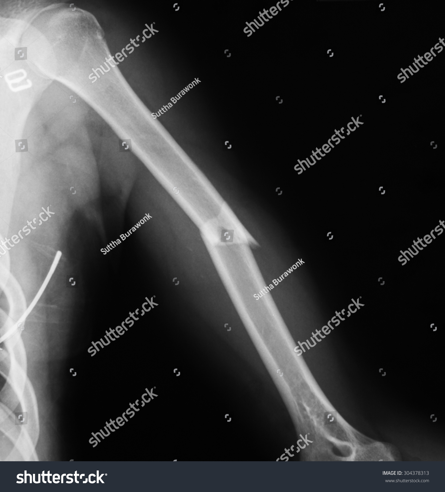 Humerus X Ray