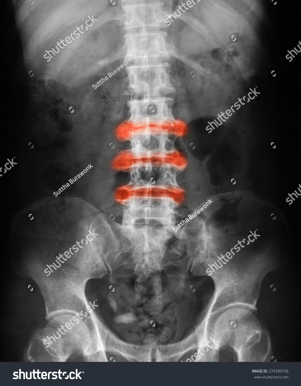 X-Ray Image Of L-S Spine, Ap (Anteroposterier) View, Show Ankylosing ...