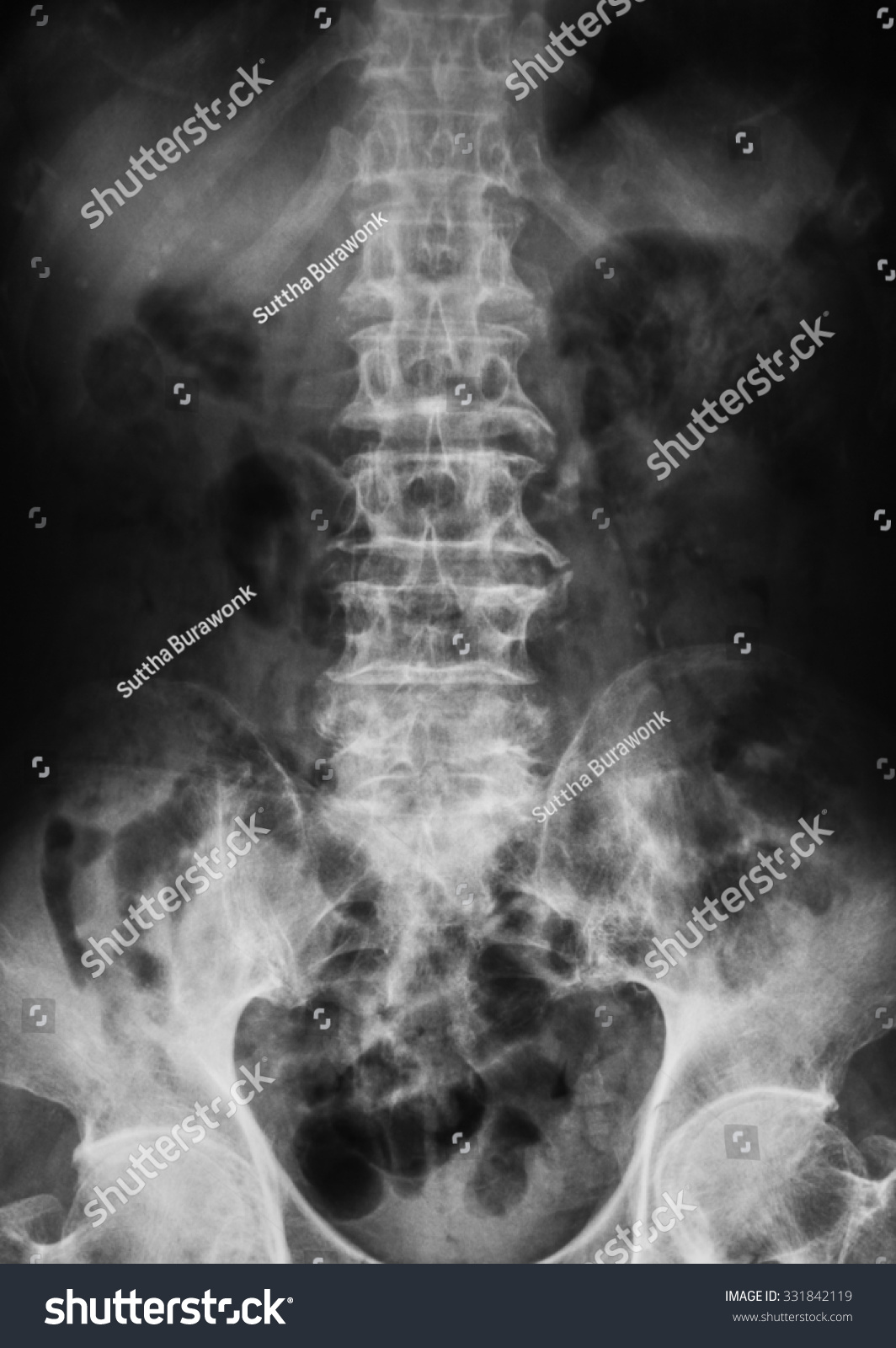 Xray Image Lumbar Spine Shows Osteoarthritis Stock Photo 331842119 ...