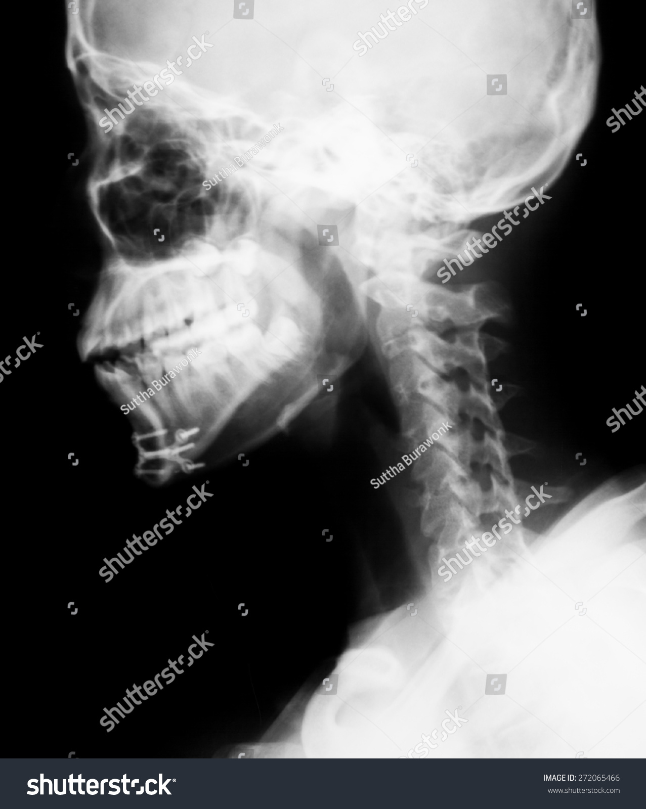 X-Ray Image Of Mandible Fracture After Treating By Using Screws. Stock ...