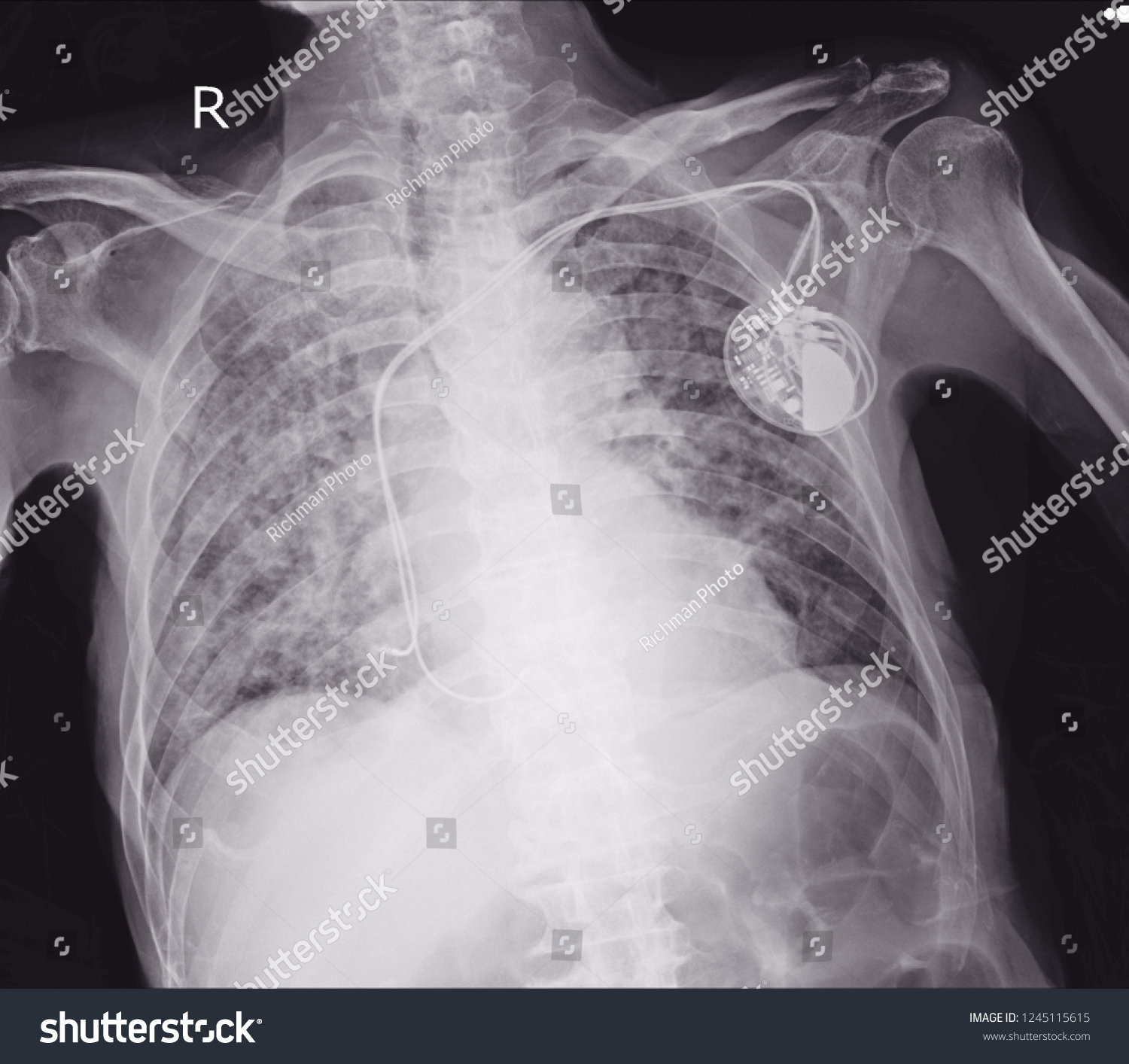 Xray Image Permanent Pacemaker Implant Body Stock Photo (Edit Now ...