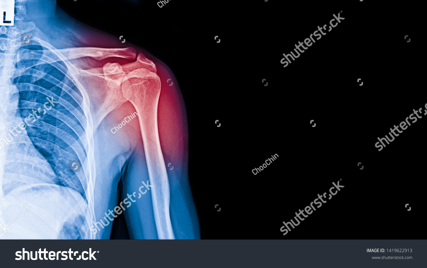 when is muscle pain xray