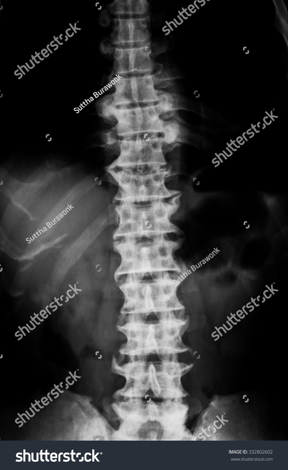 Xray Image Thoracolumbar Spine Shows Osteoarthritis Stock Photo ...