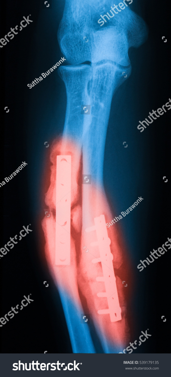 Xray Image Ulna Radius Fractures Internal Stock Photo 539179135 ...