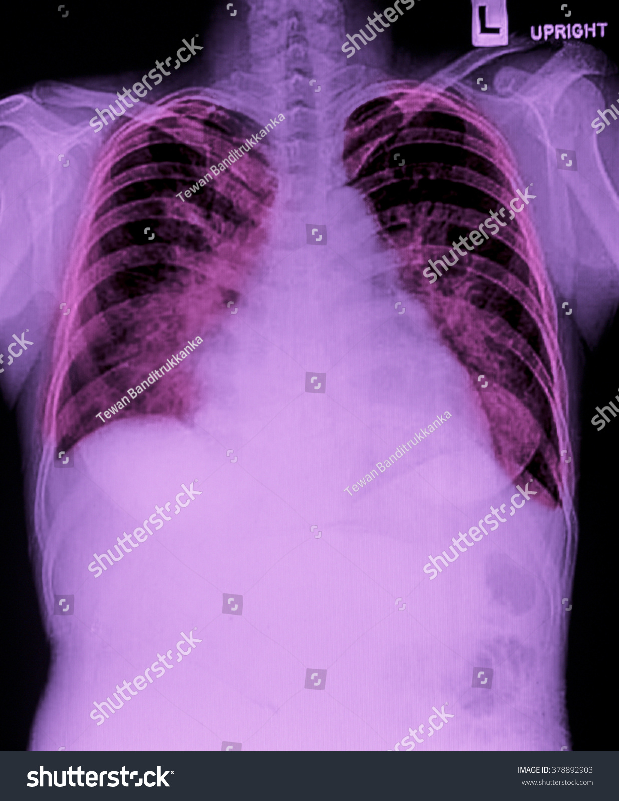 Xray Image Woman Chest Medical Diagnosis Stock Photo 378892903 ...