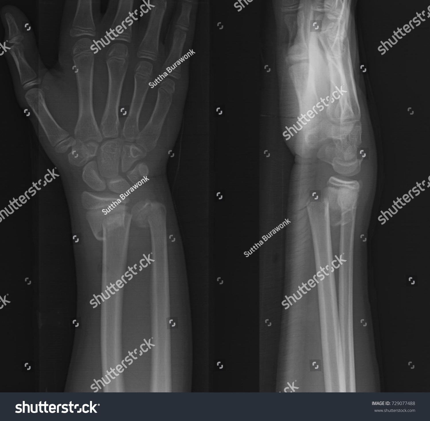 Xray Image Wrist Joint Wooden Splint Stock Photo 729077488 | Shutterstock