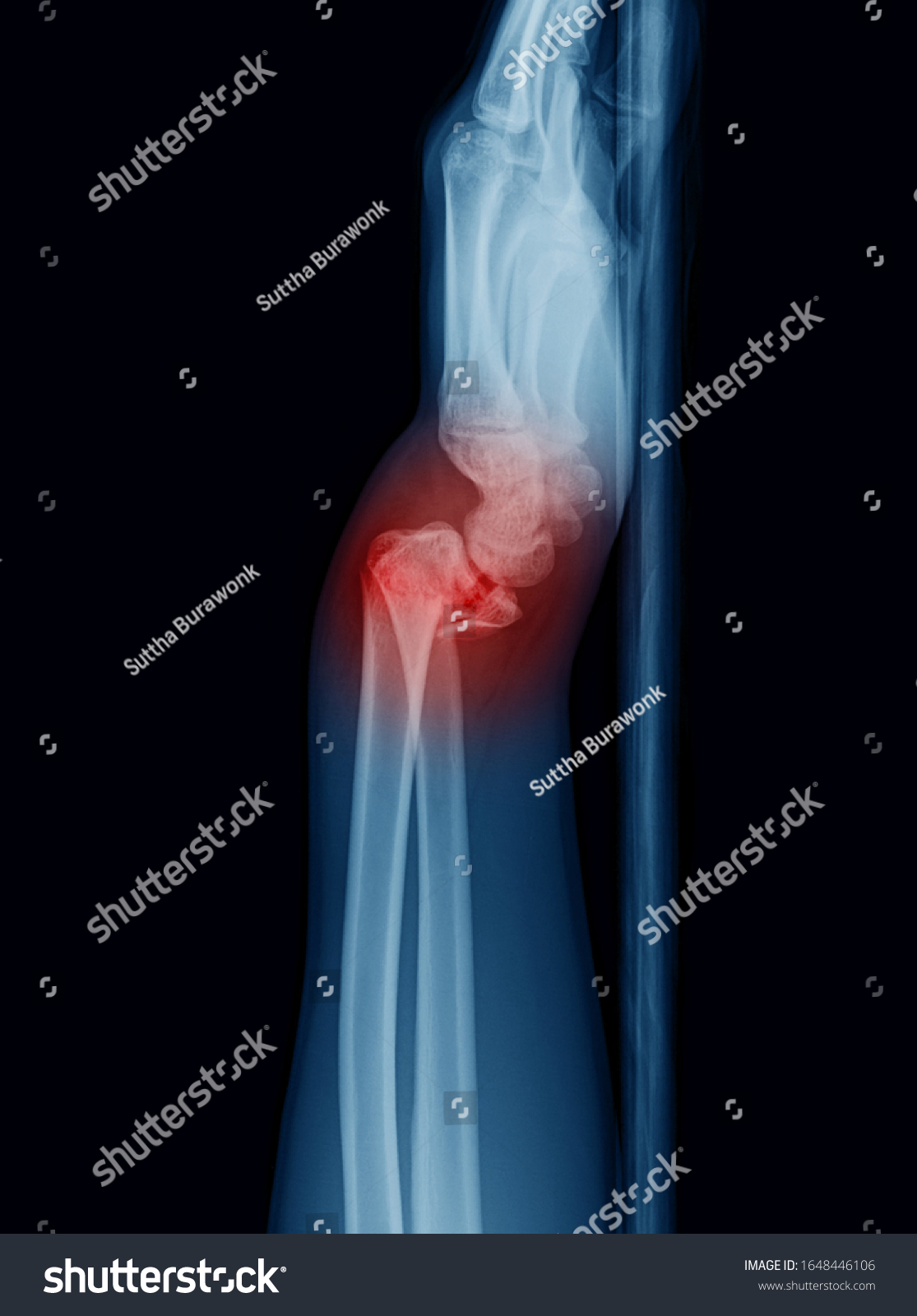 Xray Image Wrist Joint Lateral View Stock Photo 1648446106 | Shutterstock