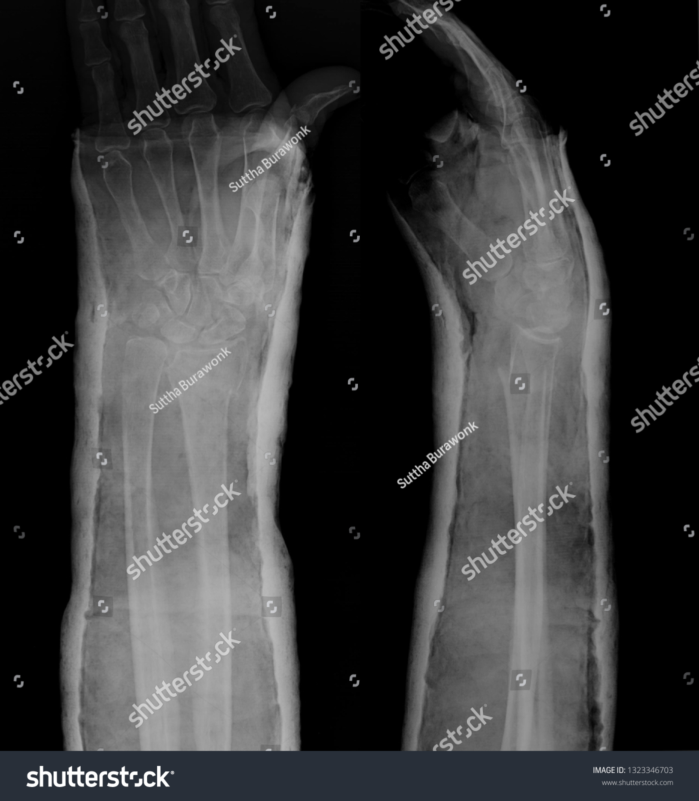 Xray Image Wrist Joint Plaster Cast Stock Photo 1323346703 | Shutterstock