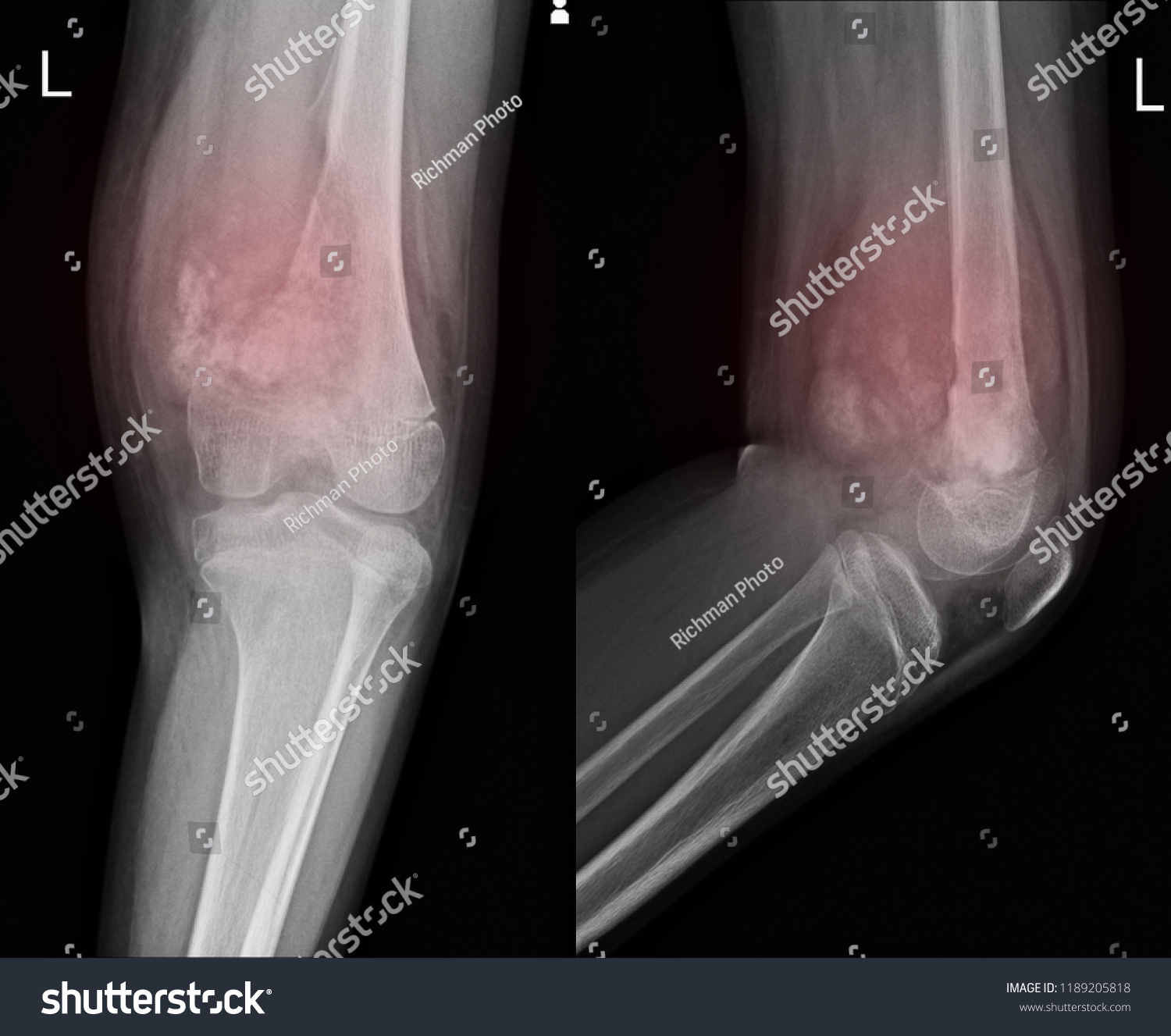 Xray Knee Join Showing Large Osteolytic Stock Photo (Edit Now) 1189205818