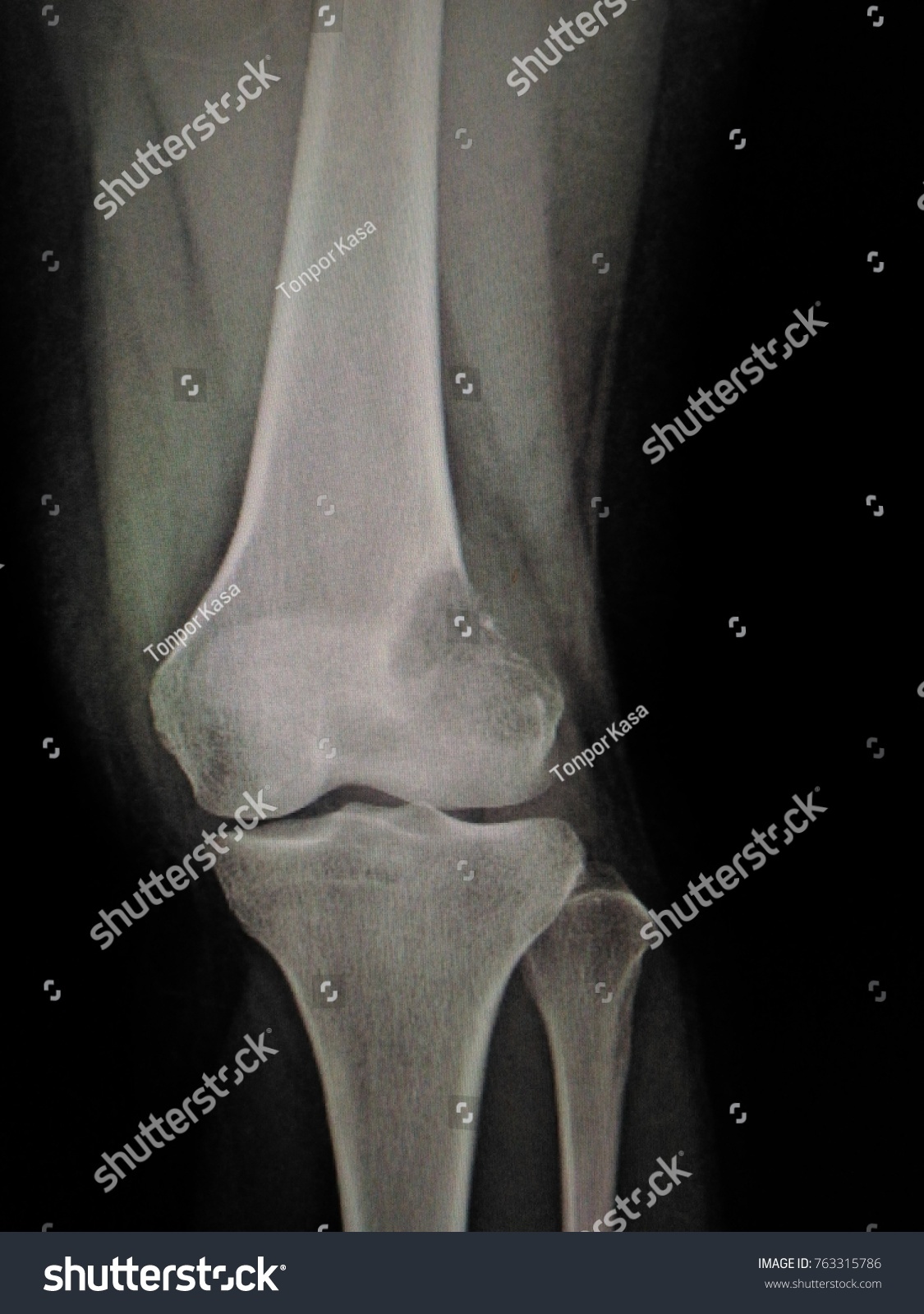 Xray Knee Joint Aplateral Geographic Osteolytic Stock Photo (Edit Now ...