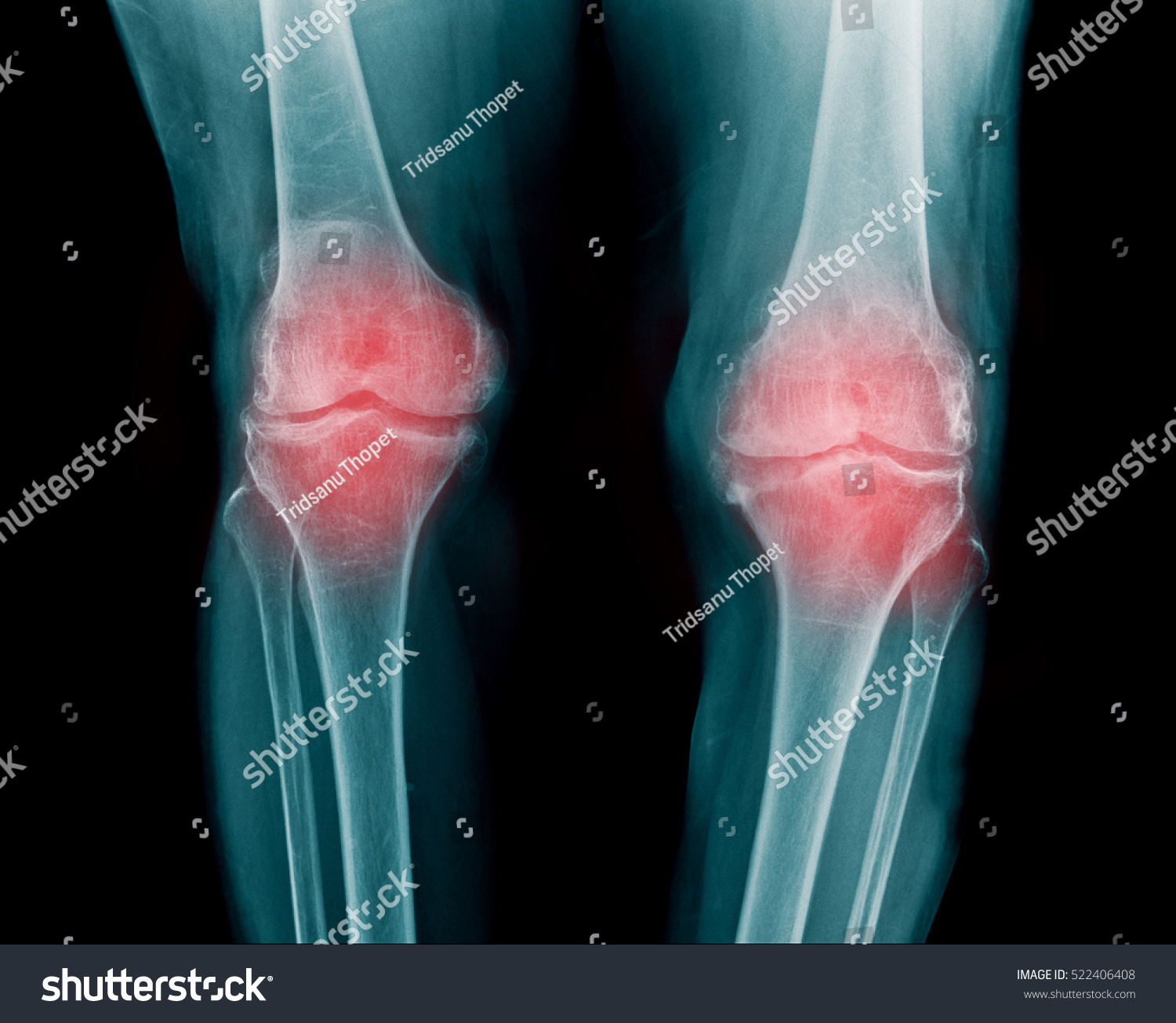 Xray Knee Joint Show Severe Osteoarthritis Stock Photo 522406408 ...