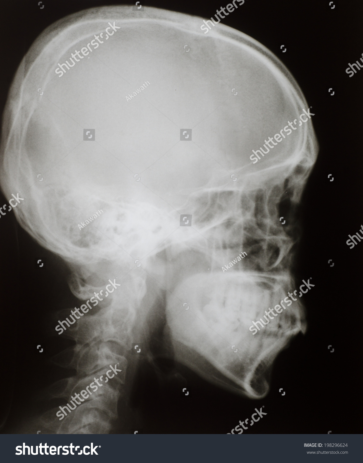 Xray Lateral Skull Stock Photo 198296624 | Shutterstock