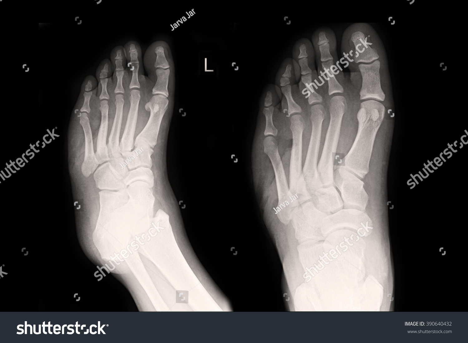 Xray Left Foot Stock Photo 390640432 | Shutterstock