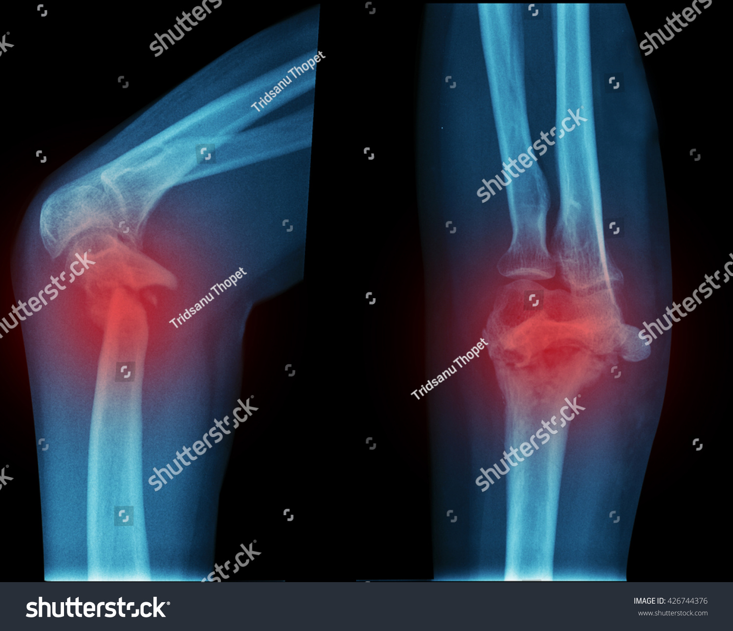 Xray Leg Fracture Tibia Bone On Stock Photo (Edit Now) 426744376