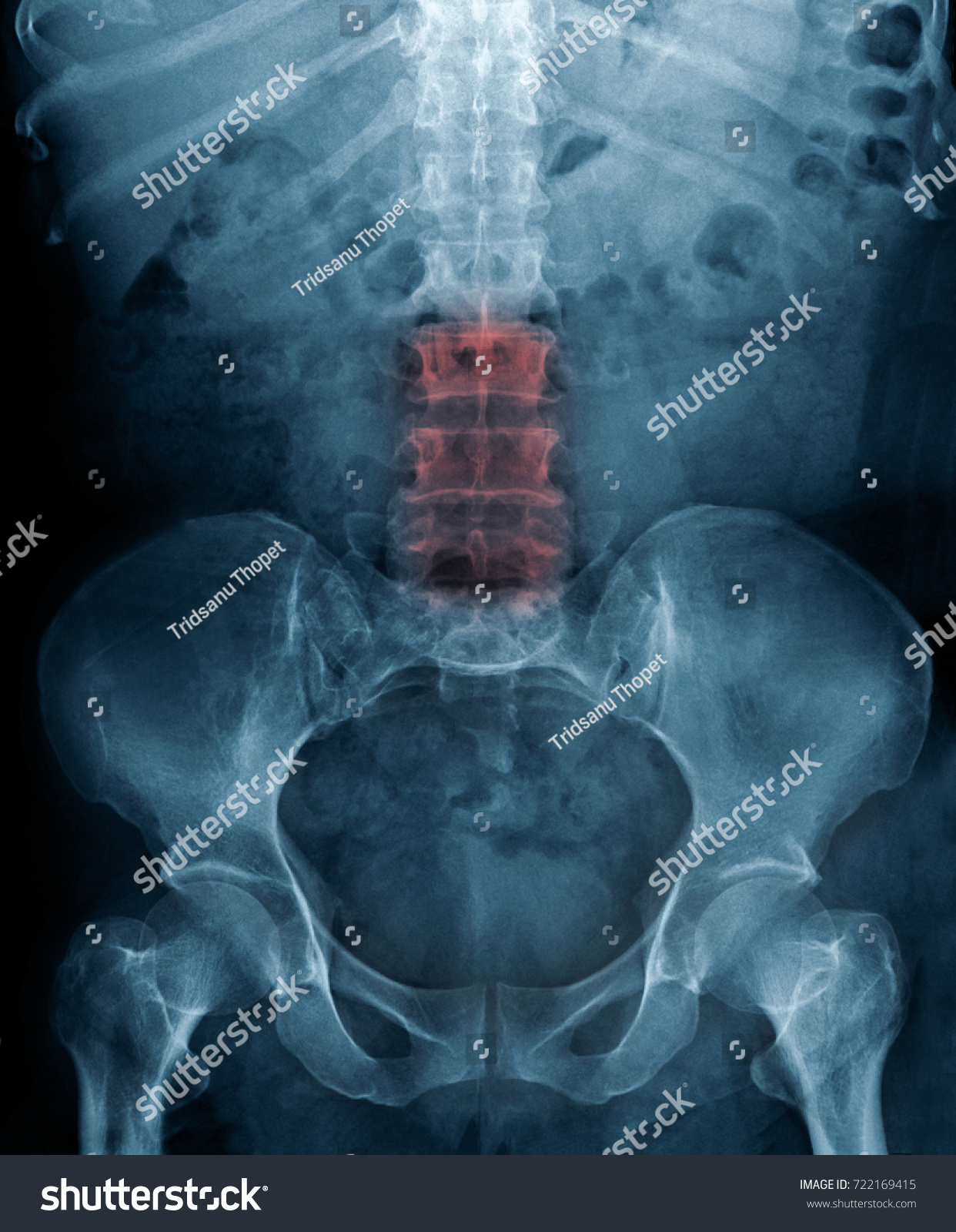 Xray Lumbar Spondylosis Stock Photo (Edit Now) 722169415