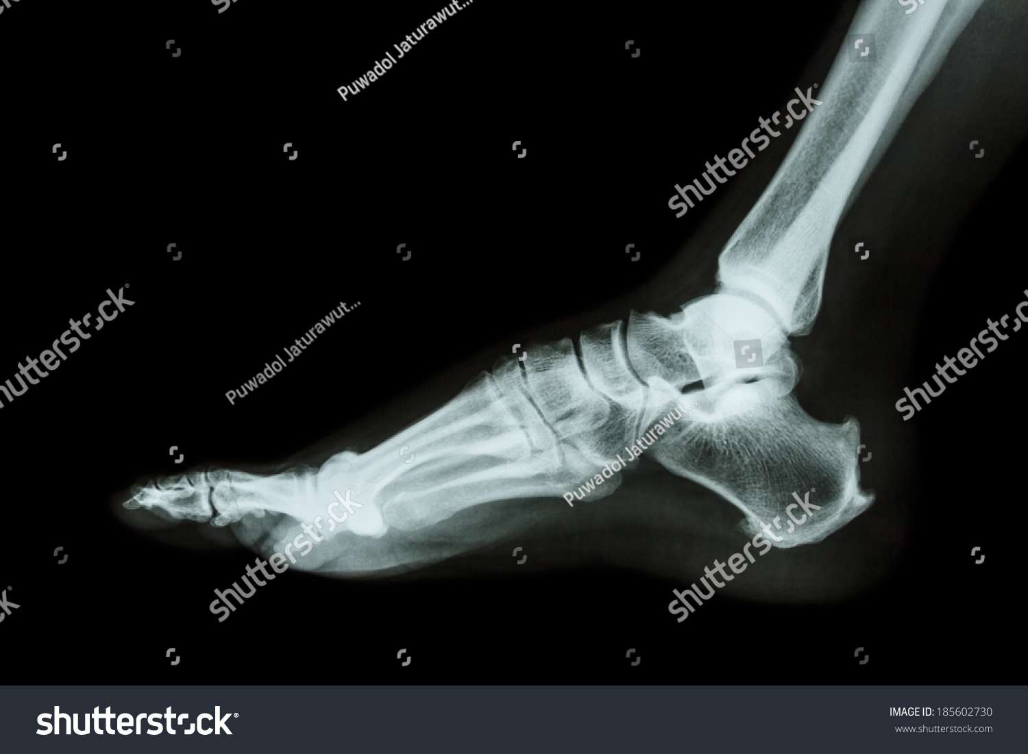 Xray Normal Foot Lateral Stock Photo 185602730 - Shutterstock