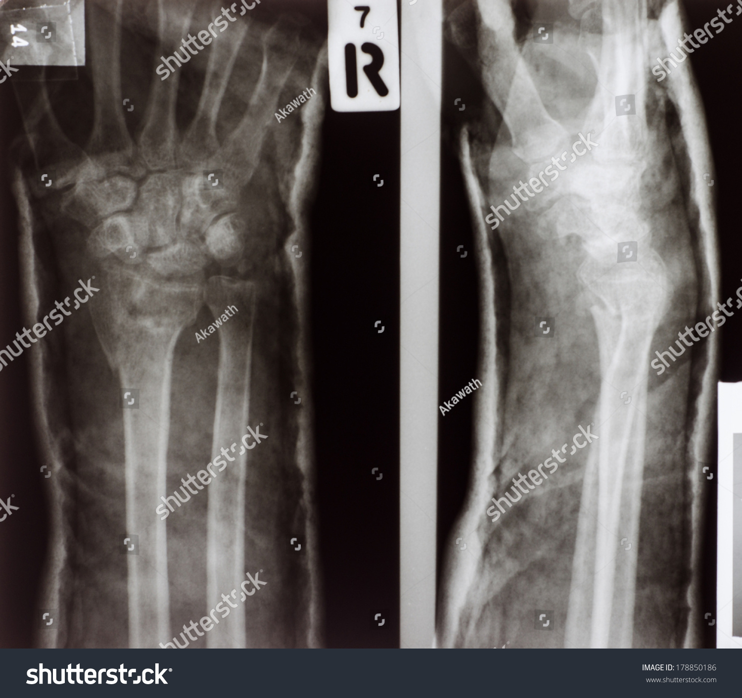 Xray Broken Arm On Splint Fracture Stock Photo (Edit Now) 178850186