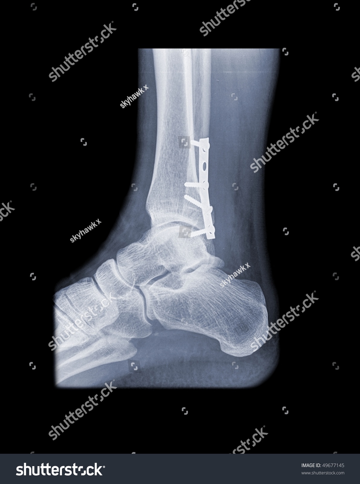 X-Ray Of A Foot With Plate And Screws Seen From The Side Stock Photo ...