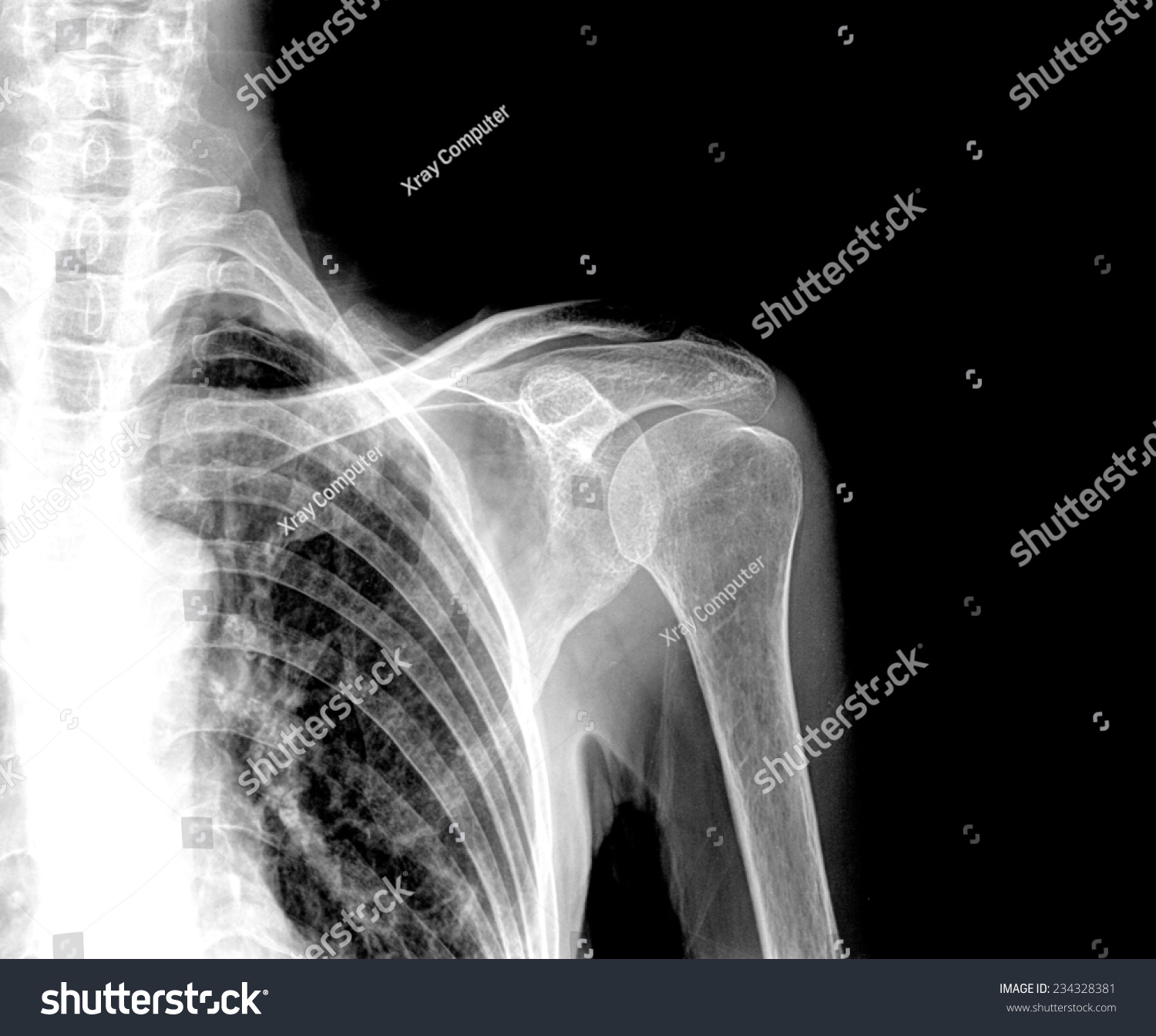 xray-fractured-upper-arm-anteriorposterior-view-stock-photo-234328381