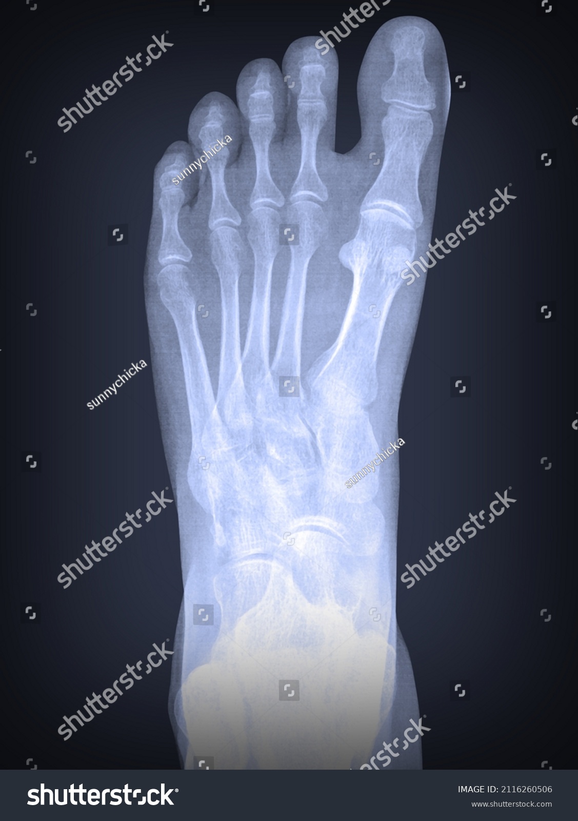 Xray Left Foot Osteoporosis Damage Stock Photo (Edit Now) 2116260506