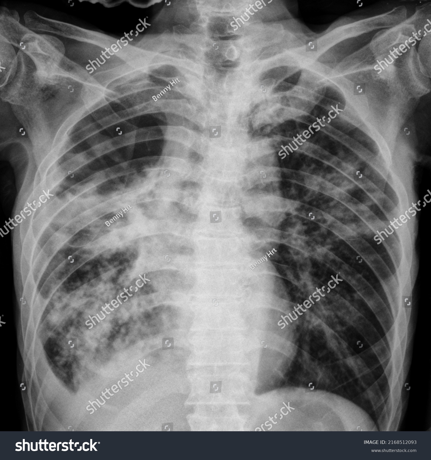 Xray Abnormalities Lungs Due Lung Infection Stock Photo 2168512093 ...