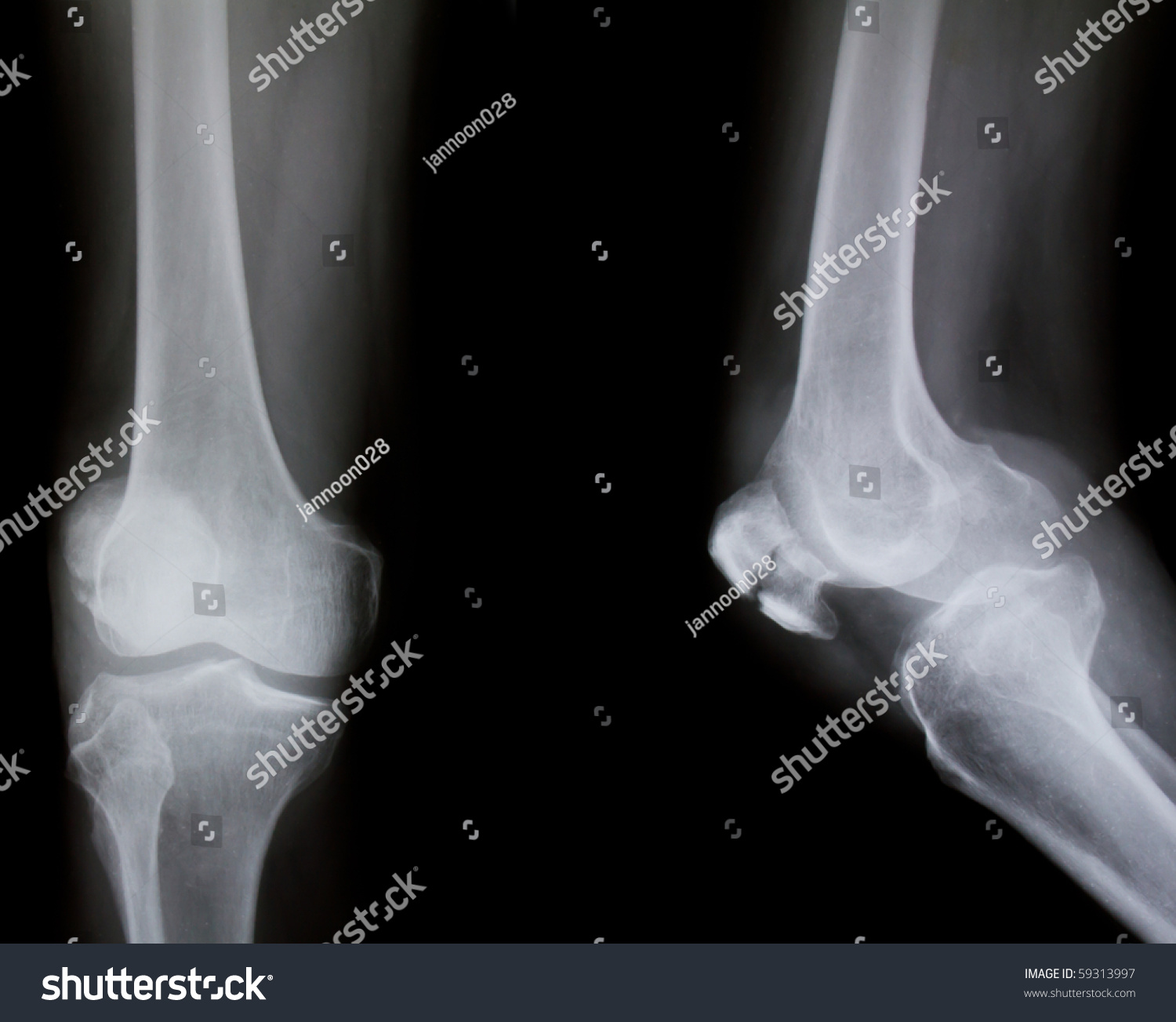 X-Ray Of Both Human Knee (Broken Knee) Stock Photo 59313997 : Shutterstock