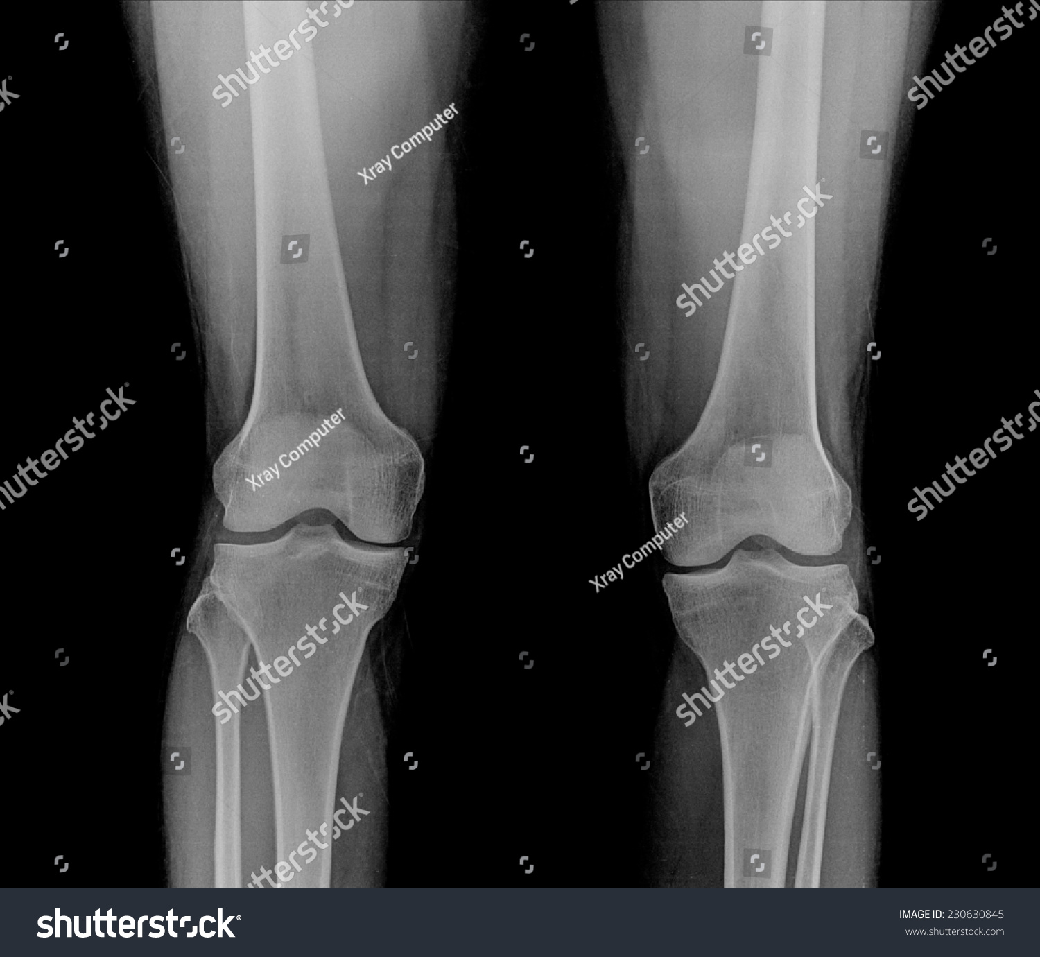 X-Ray Of Both Human Knees. Stock Photo 230630845 : Shutterstock