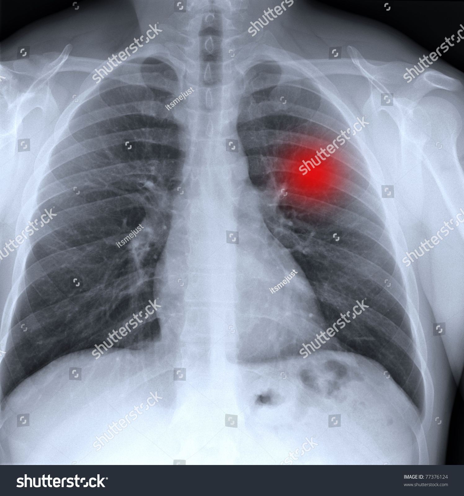 X-Ray Of Cancer In Chest / Many Others X-Ray Images In My Portfolio ...