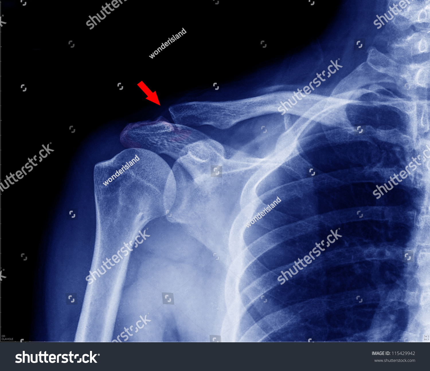 X Ray Collarbone Stock Photo 115429942 Shutterstock