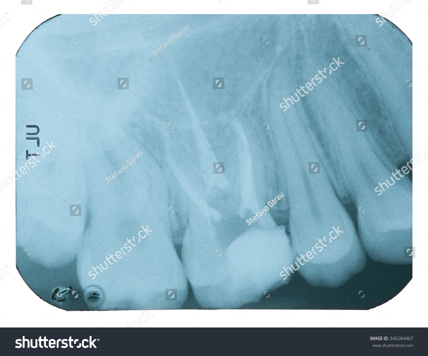 Xray Dental Filling Revitalization Stock Photo 340284467 | Shutterstock