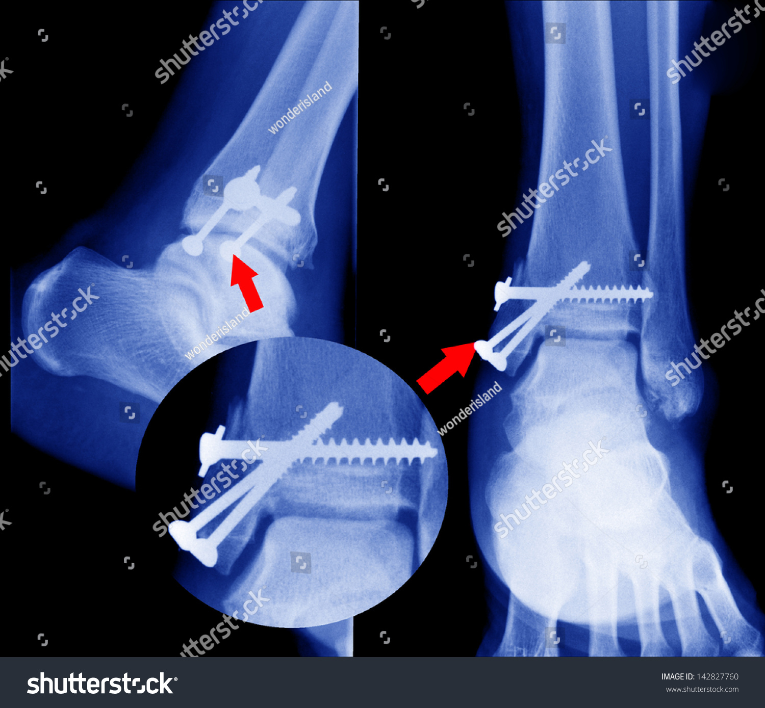 X Ray Fractures Bone Stock Photo (Edit Now) 142827760