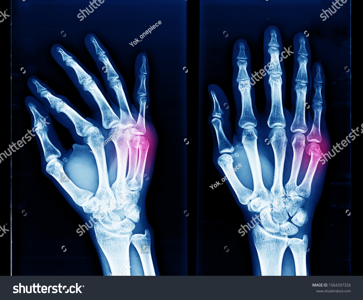 Xray Hand Wrist Showing Closed Fracture Stock Photo (Edit Now) 1564337326