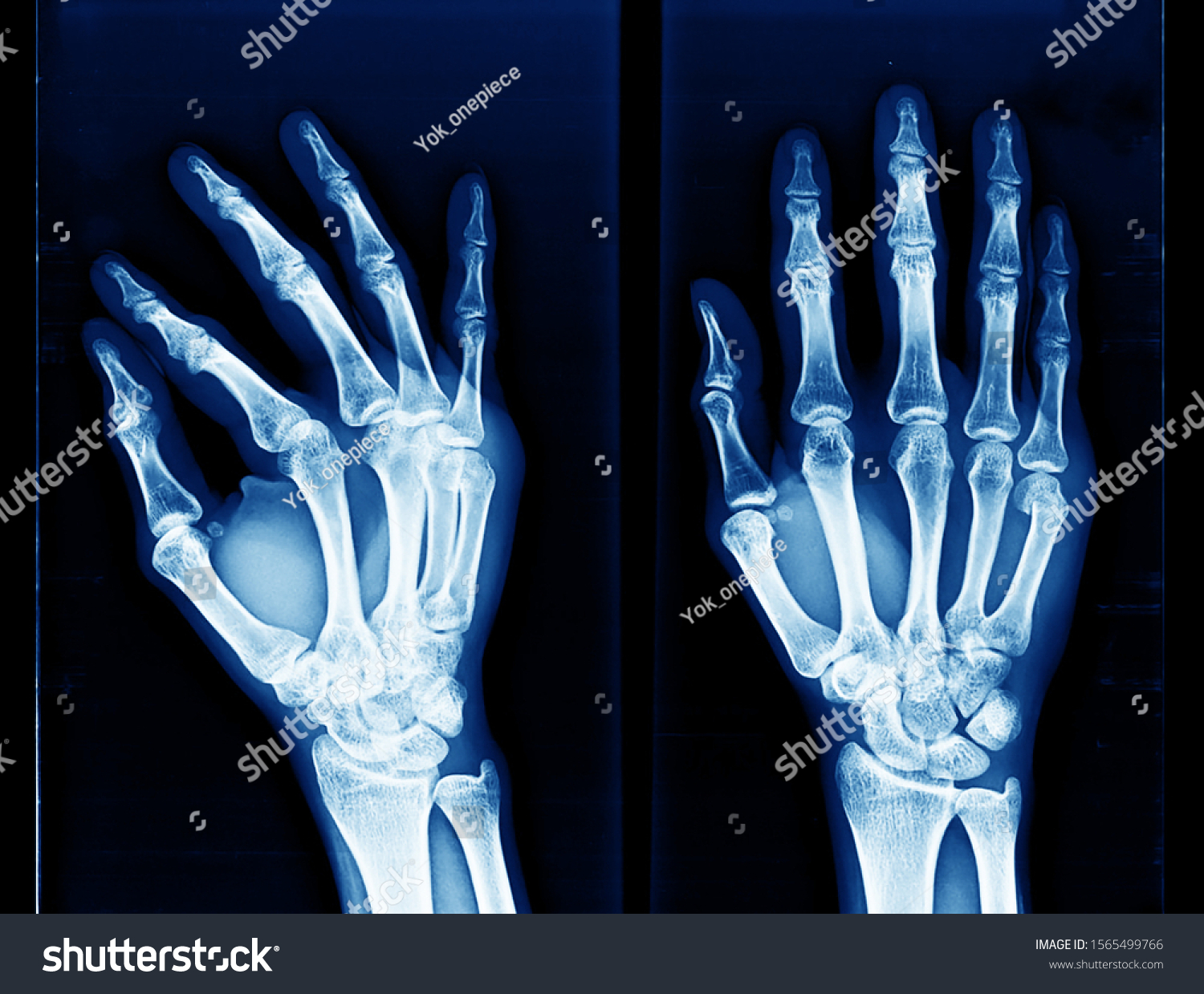 Xray Hand Wrist Showing Closed Fracture Stock Photo (Edit Now) 1565499766