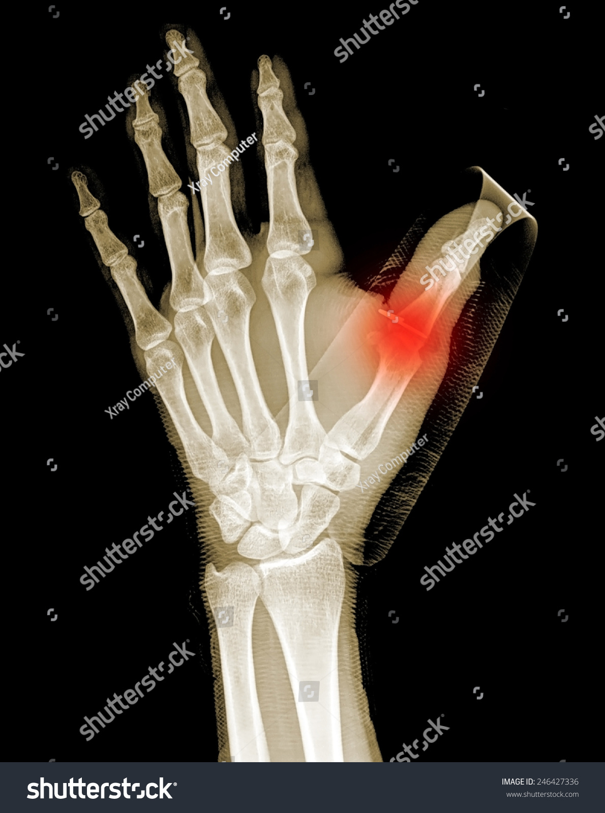 Xray Hand Fractures Thumb Painful Stock Photo 246427336 | Shutterstock