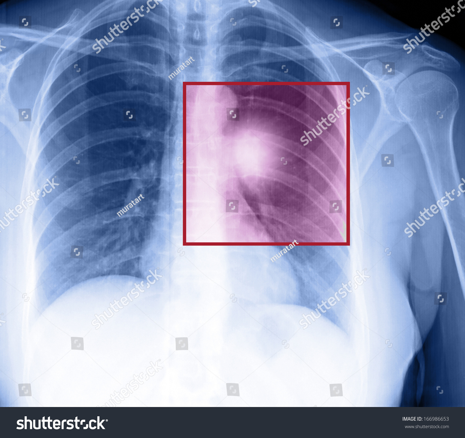 X-Ray Of Human Cancer Lungs Stock Photo 166986653 : Shutterstock
