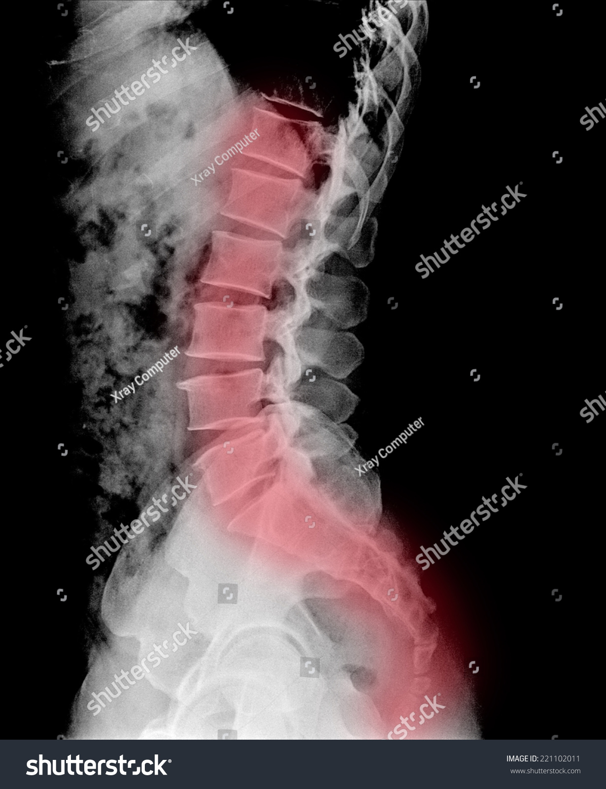 X Ray Human Lumbar Spine Lateral Stock Photo 221102011 - Shutterstock