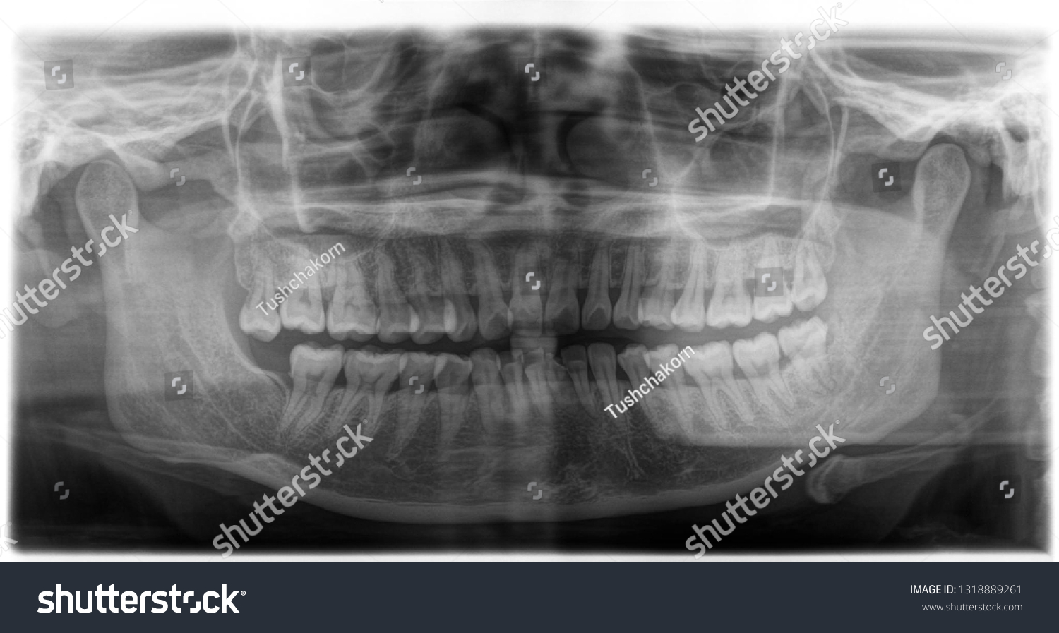 X Ray Human Mouth Teeth Bones Stock Photo (Edit Now) 1318889261