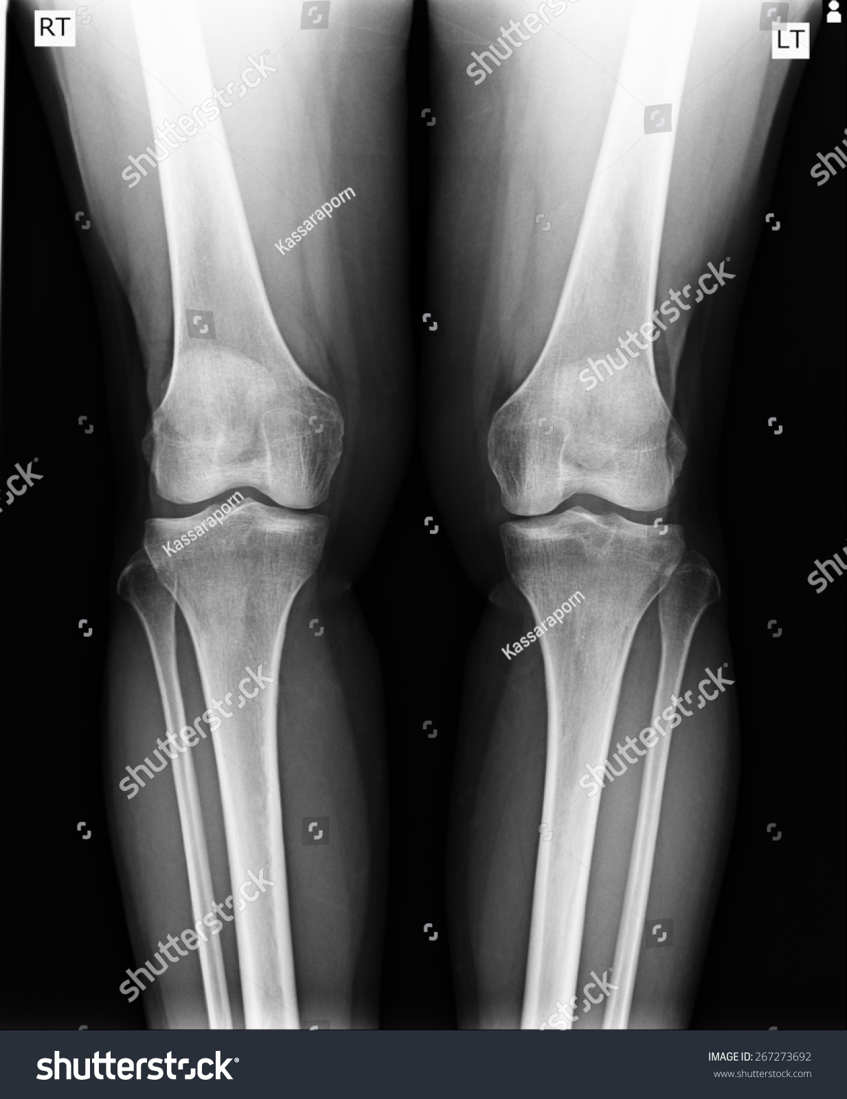 Xray Knee Joint Advanced Osteoarthritis Stock Photo 267273692 ...